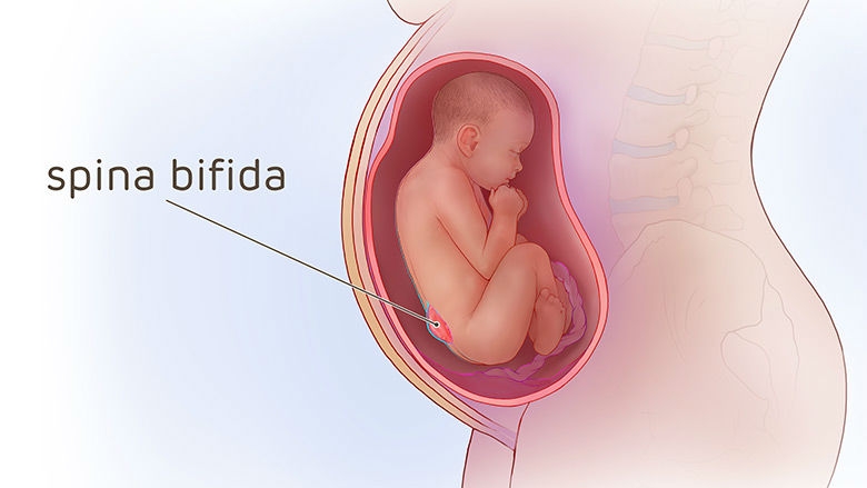 cirurgia-de-espinha-bifida-para-recem-nascidos-e-adultos