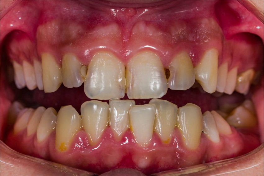 dente-frontal-da-cavidade