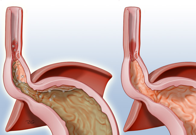 hernia-hiatal