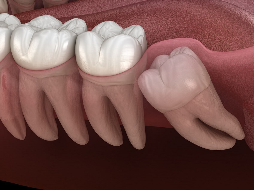 pontos-de-dente-do-siso