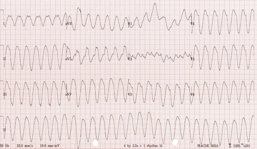 taquicardia-ventricular-sem-pulso