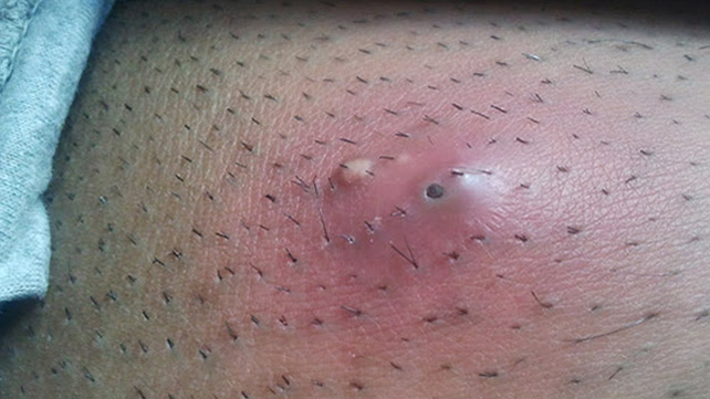 tratamento-e-prevencao-de-pelos-pubicos-encravados