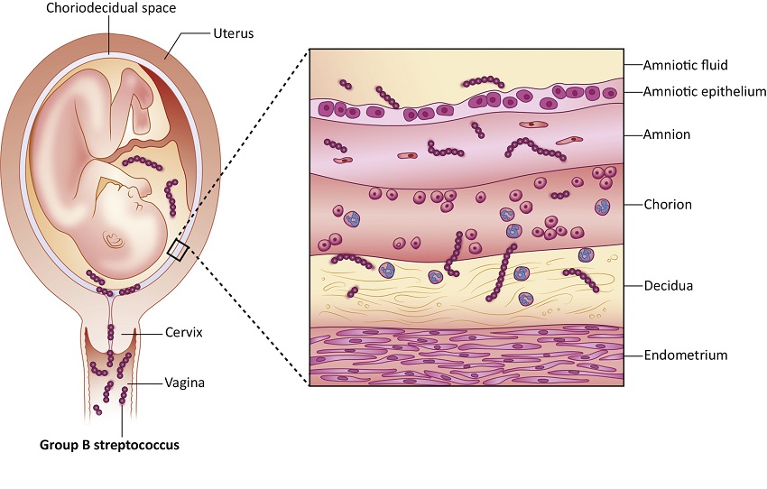 gravidez-estreptococica-grupo-b