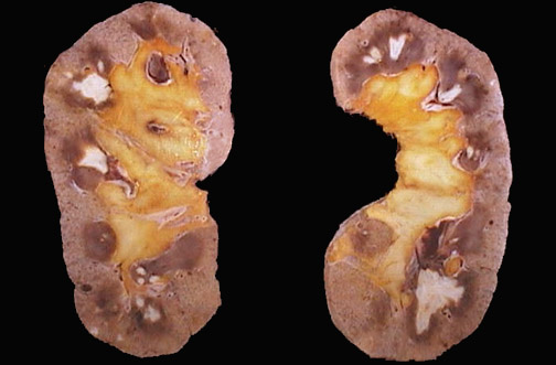 necrose-papilar-renal