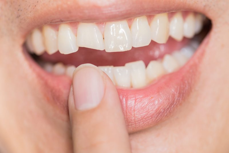 procedimento-de-reparo-de-dente-lascado