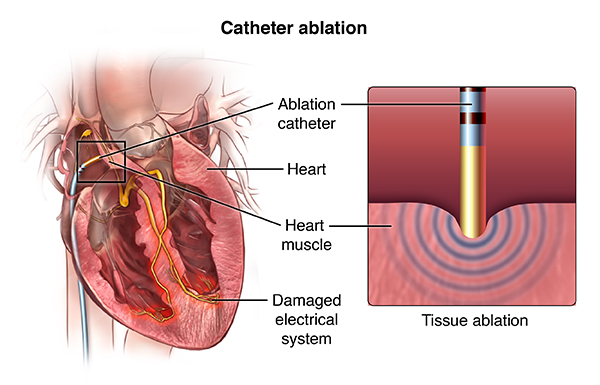 procedimentos-de-ablacao-cardiaca