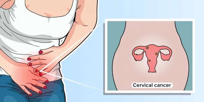 sintomas-de-cancer-cervical