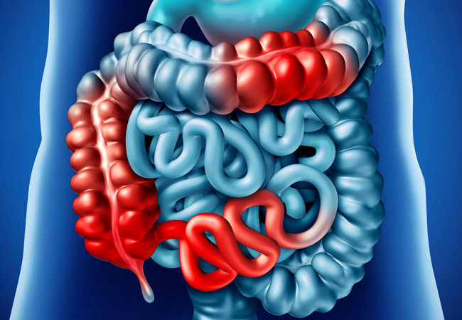 doenca-de-crohn-adultos-mais-velhos