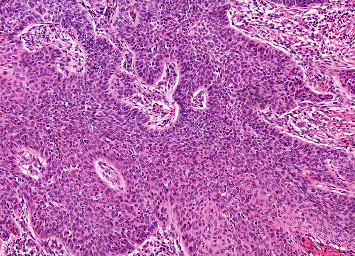 epiglote-de-carcinoma-de-celulas-escamosas