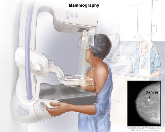 mamografia