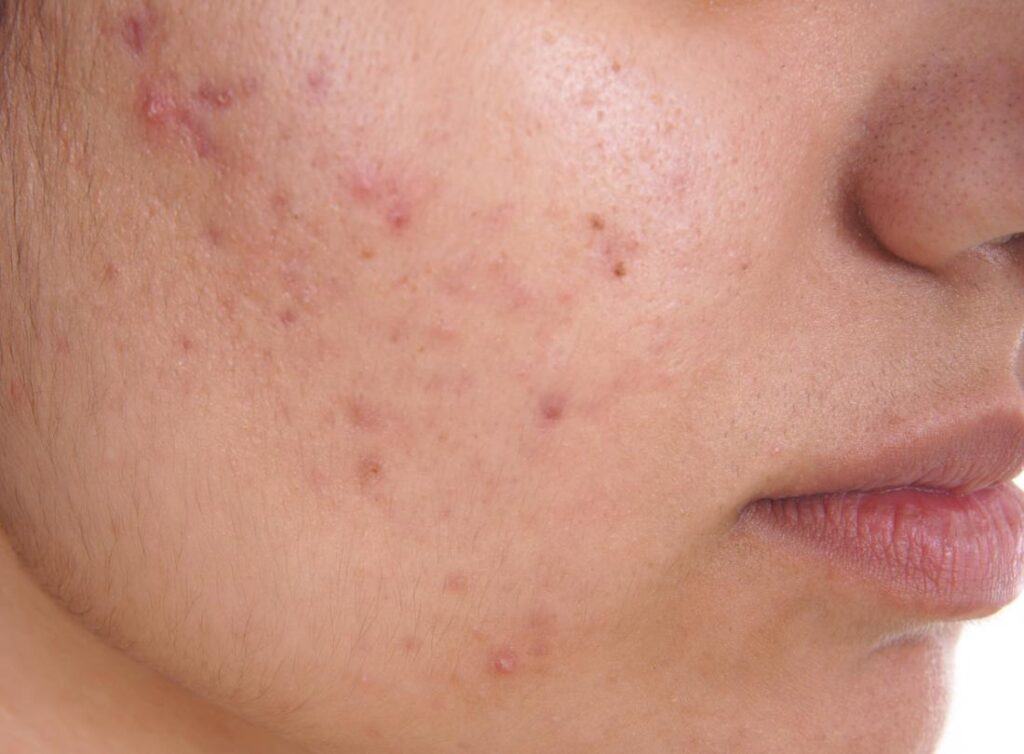 melhores-antibioticos-topicos-acne