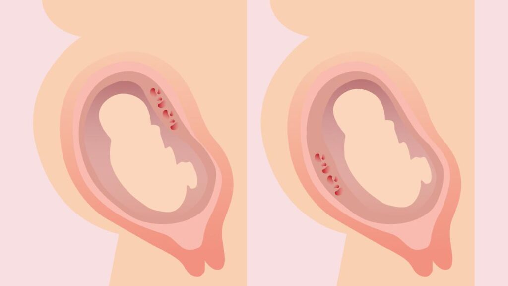 placenta-posterior-do-fundo-medio