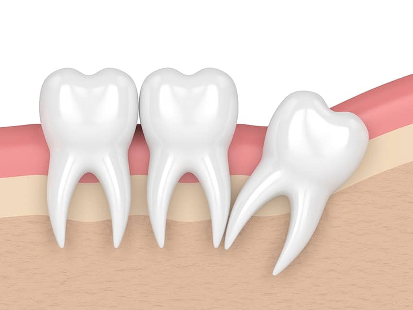 sinta-melhor-os-dentes-do-siso-removidos