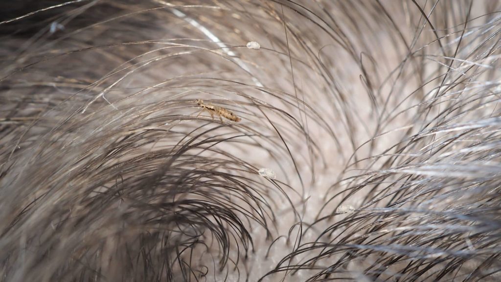 a-tintura-de-cabelo-matara-os-piolhos