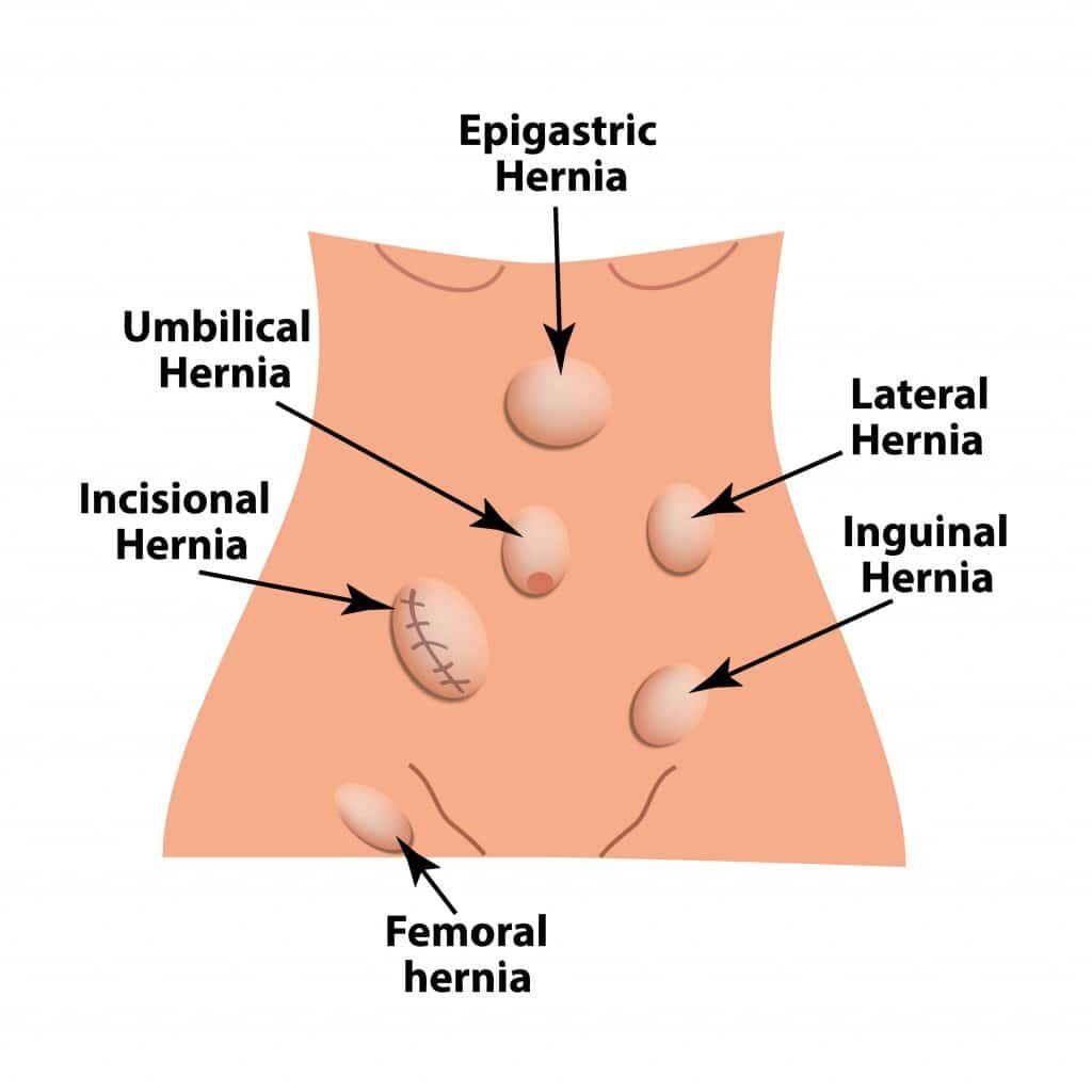 hernia-parece