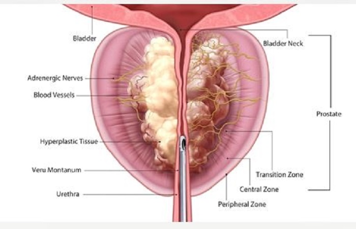 limpar-prostata