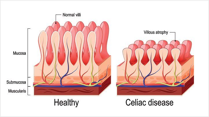 testar-doenca-celiaca