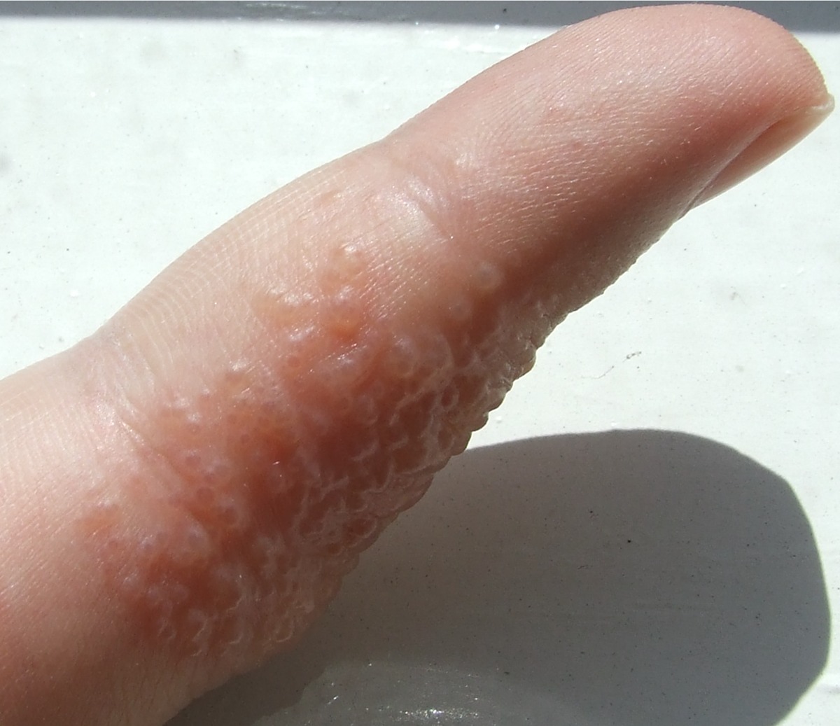 eczema-de-pomfolix