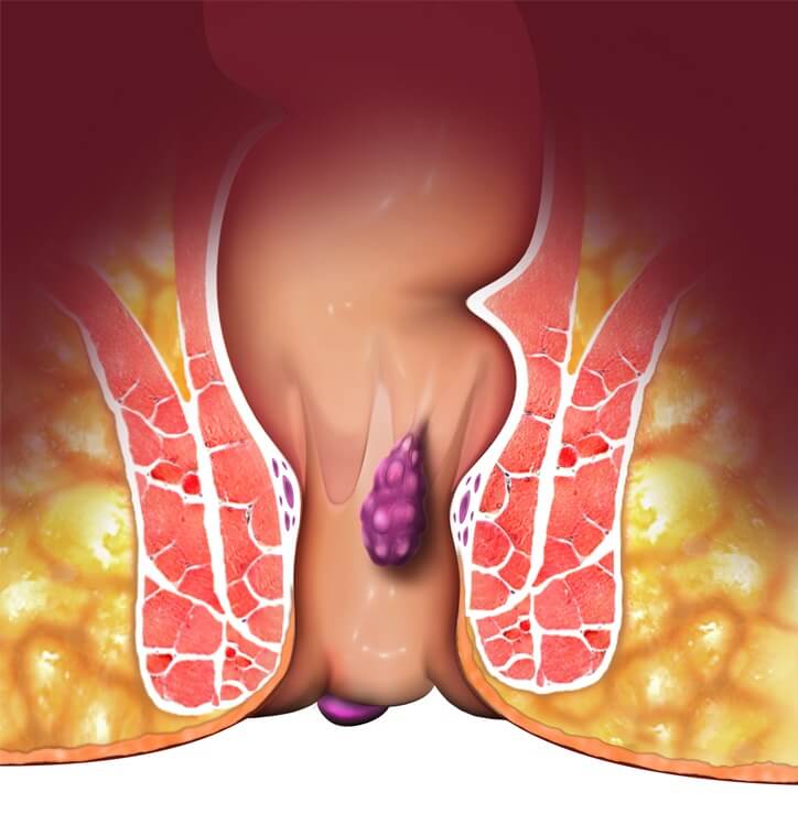 hemorroida-trombosada