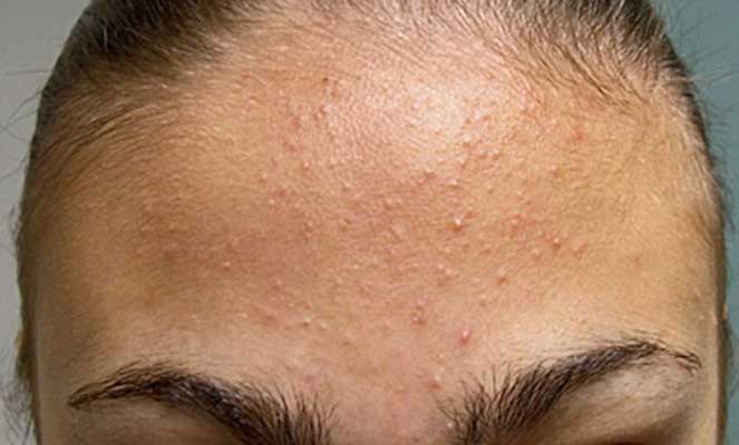 quais-sao-os-diferentes-tipos-de-acne