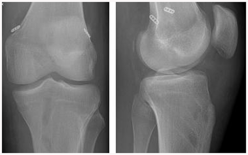 substituicao-acl