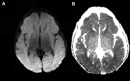 cegueira-cortical