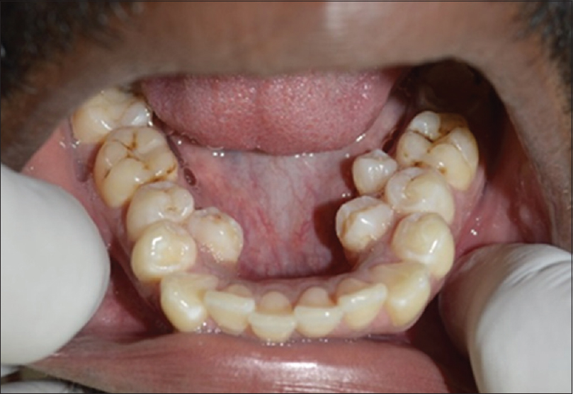 dentes-supranumerarios-hiperdontia