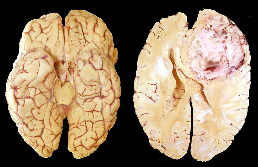 glioblastoma-multiforme