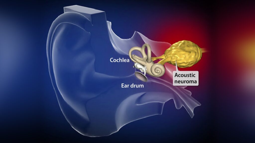 neuroma-acustico