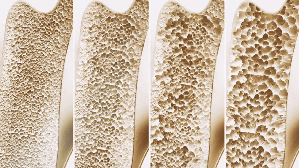 osteopenia