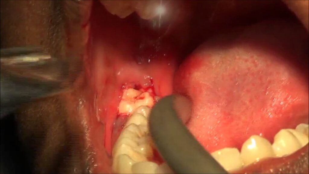 pericoronitis