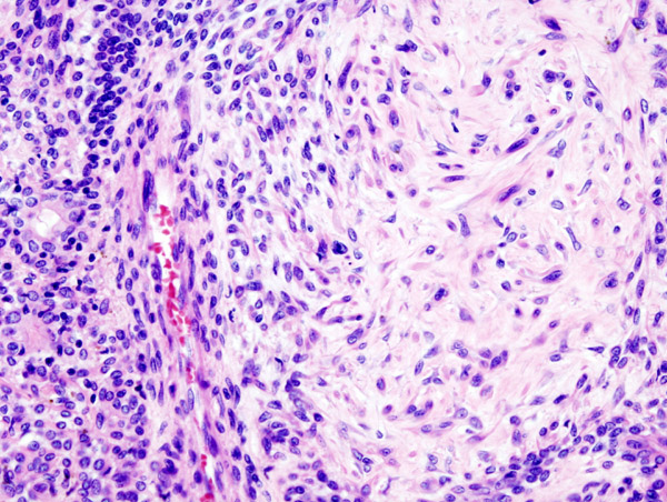 adenoma-pleomorfico