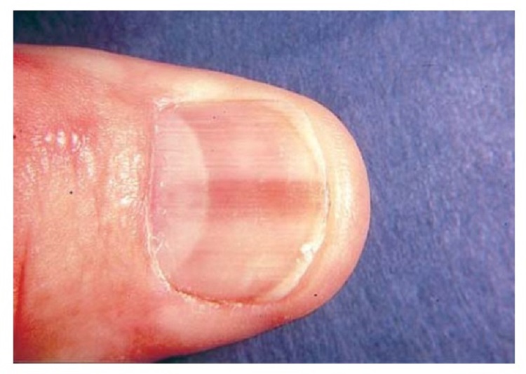 Tumor Glomus saudedia Tumor Glomus saudedia