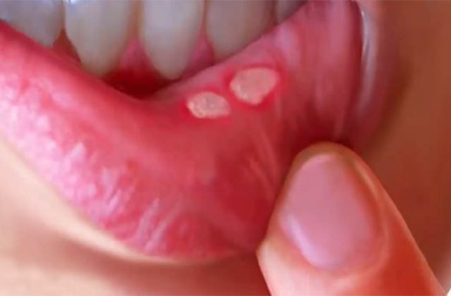 alivio de ulceras na boca