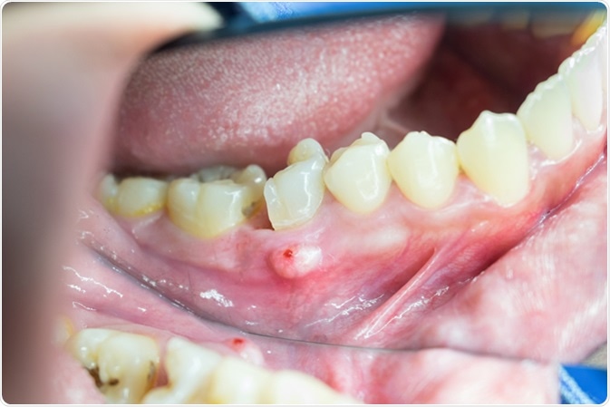 causas de abscesso dentario