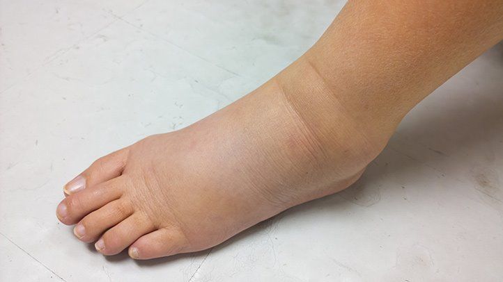 edema