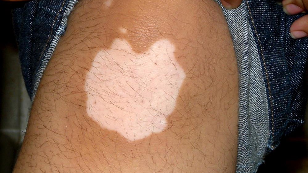 como prevenir e reduzir manchas brancas no vitiligo da pele