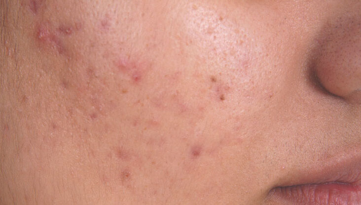 desaparecer cicatrizes de acne