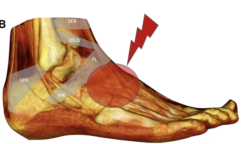 tendinite extensora