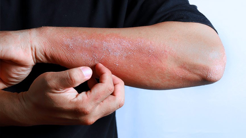 tratamento de eczema