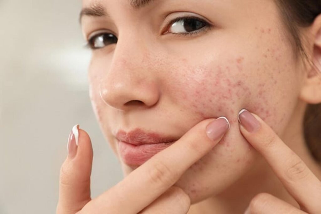 remedios caseiros para acne