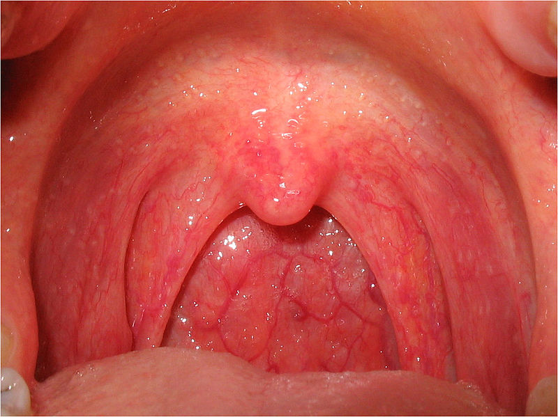 garganta inflamada ou amigdalite