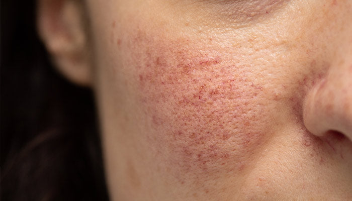 o que e rosacea