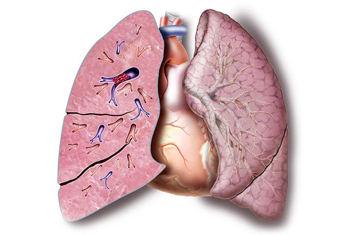 embolia pulmonar