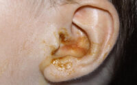 infeccoes de ouvido em criancas